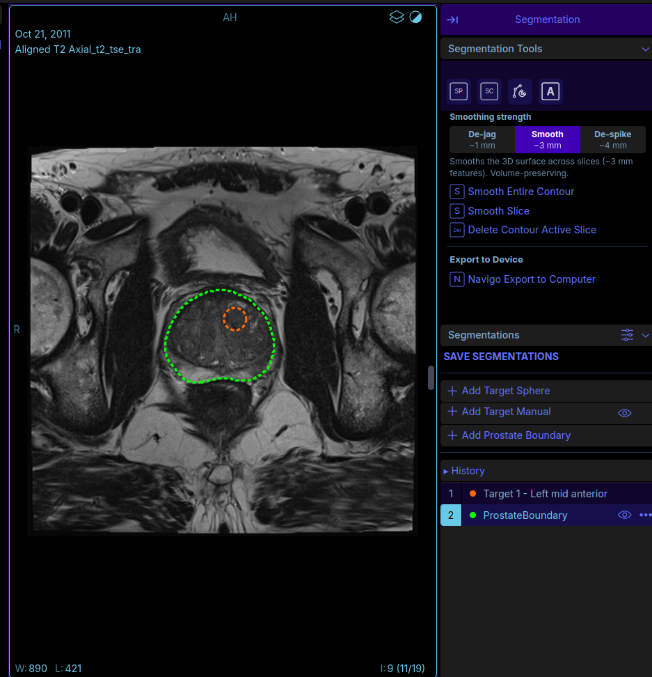 Segmentation panel with target placement and contour smoothing controls beside an axial T2 image