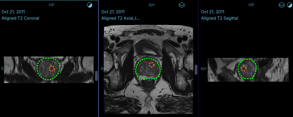 A prostate boundary and lesion target shown in coronal, axial, and sagittal views