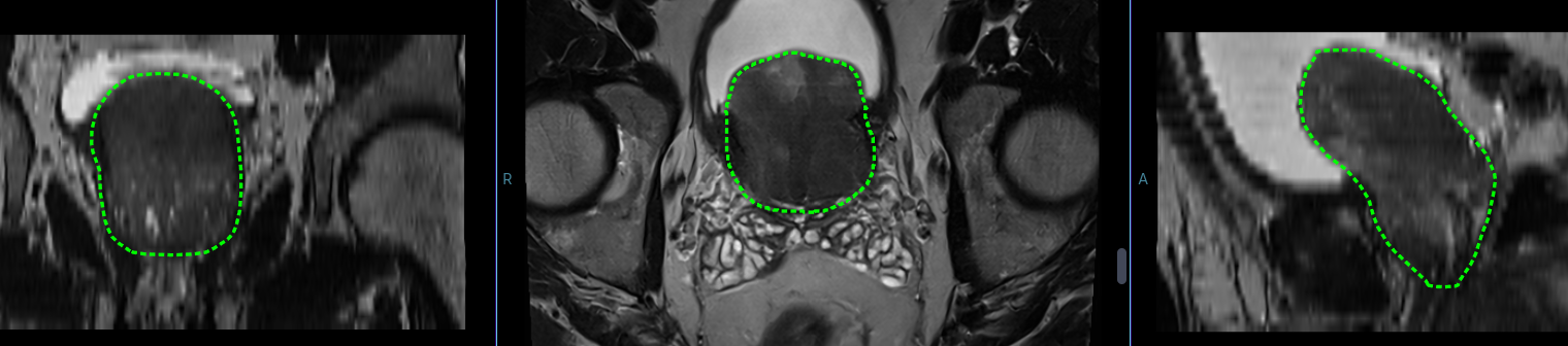 AI prostate boundary contour shown in the coronal, axial, and sagittal planes on T2-weighted MRI